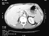 Normal CT of the Abdomen.