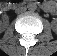 Normal CT myelogram.