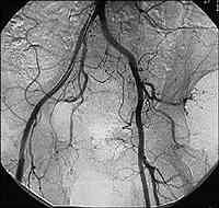 Normal pelvic angiogram.