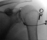 Shoulder arthrogram.