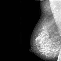 Normal mammogram.