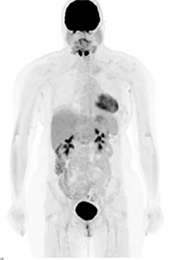 Normal PET Scan.