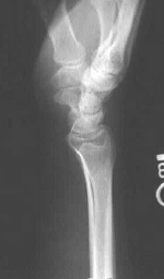 Lateral view of normal wrist